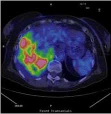 Check spelling or type a new query. Https Www Openaccessjournals Com Articles Diagnostic Imaging And Workup Of Malignant Pleural Mesothelioma Pdf