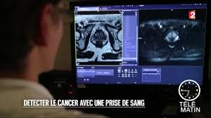 Hormis de rares cas (dosage psa pour la prostate), il n'existe pas de molécules miracles que l'on va pouvoir doser dans le sang pour diagnostiquer un cancer. Sante Detecter Le Cancer Avec Une Simple Prise De Sang 2016 04 12 Youtube