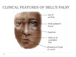 Facial nerve paralysis dr.davis -11.04.16