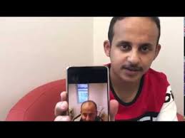 قبل و بعد زراعة الشعر تجربة السيد عبد الله من المملكة بمجموعة مشافي استماران بعد 6 اشهر Youtube
