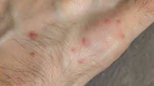 Image result for bedbugs bites