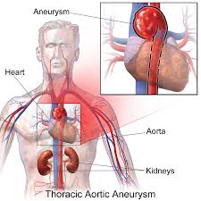 Aneurisma atau aneurysm adalah pelebaran abnormal (pembengkakan) arteri yang disebabkan oleh tekanan darah yang mengalir melalui area yang melemah. Thoracic Aortic Aneurysm Wikipedia