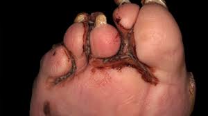 Die drakunkulose, dracunculose, dracunculiasis oder dracontiasis ist eine durch den medinawurm (dracunculus medinensis) hervorgerufene, vor allem im orient auftretende, schwere parasitose des menschen. Parasitosen Der Haut Altmeyers Enzyklopadie Fachbereich Dermatologie