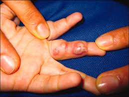 It sounds more like dyshidrotic eczema, or dyshidrosis, a skin condition in which blisters develop on the soles of your feet and/or the palms of your hands. Herpes Simplex American Academy Of Pediatrics