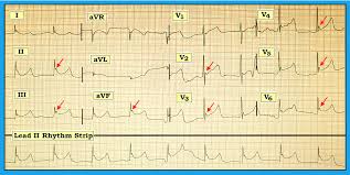 Did you take a good photo of this peak? Ecg Interpretation Ecg Blog 149 St Elevation J Point Osborn Hypothermia Pericarditis Acute Stemi