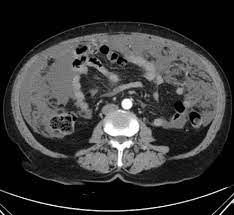 The peritoneum is tissue that covers most of the organs in the abdominal cavity. Peritoneal Metastases Radiology Reference Article Radiopaedia Org