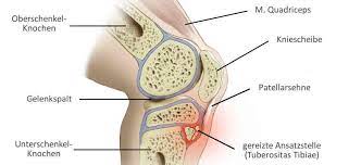 Morbus Osgood Schlatter Richtig Behandeln Komplikationen Verhindern