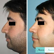 Le nez va dégonfler très lentement. Ethnique Rhinoplastie Istanbul Turquie Sante Turquoise Esthetique