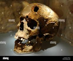 Image result for Skull Trephination