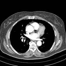 Tc spirale multidetettore 16 mdct. Embolia Polmonare Quadro Angiotac Daddydoctorgym Com