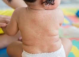 Image result for sweat rash on back baby
