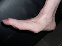 L'espérance de vie des patients restent très courte. Qu Est Ce Un Pied De Charcot Bbot Upbto Orthopedie