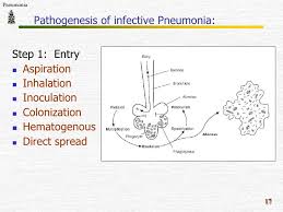 Validated prediction scores for pneumonia severity can guide the decision between outpatient and inpatient therapy. Pathology Of Pneumonia