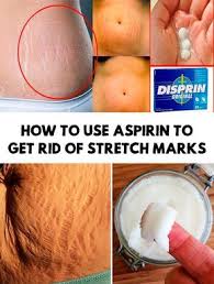 Stretch Marks 4 Diy Ways To Get Rid Of Stretch Marks Stretch Marks Stretch Marks On Thighs Stretch Mark Remedies