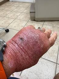 Image result for Hand Infection