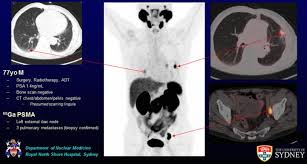 Select centre belfast, ulster hospital laois, midland regional hospital, portlaoise antrim, area hospital belfast, musgrave park hospital cork, alliance. Prostate Pet Ct Targets More Cancer And Improves Patient Care Eurekalert Science News