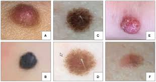 Image result for Spitz Nevus