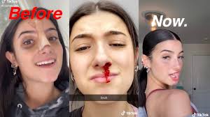 Charli Damelio Nose Job Check Full Tiktok Deleted Video Youtube