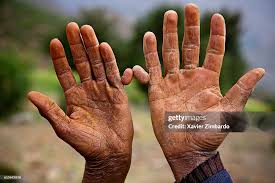 Image result for Polydactyly