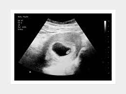 0 weeks pregnant (40 pictures) 1 weeks pregnant (5 pictures) 2 weeks pregnant (14 pictures) 3 weeks pregnant (35 pictures) 4 weeks pregnant (75 pictures) 5 weeks pregnant (292 pictures) 6 weeks pregnant (582 pictures) 7 weeks pregnant (627 pictures) 6 Weeks Series Design B Fake Ultrasound W Instant Download