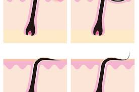 It can also lead to increased sensitization and inflammation. The Secret To Removing Ingrown Hairs On Legs Forever