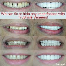 Do You Have Missing Or Stained Teeth But Think You Don T Qualify For Veneers You Do Qualify For Trusmile Veneers Yo Snap On Smile Veneers Perfect Smile Teeth