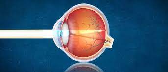 Nachstar Lasern Mit Yag Laser Schnelle Terminvergabe Alle Kassen