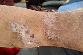 Image result for scabies on humans