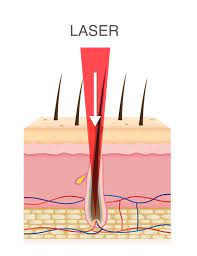 When performed correctly, laser hair removal kills the follicle of hair and is extremely targeted without affecting the skin. Home Laser Ipl Hair Removal Everything You Need To Know
