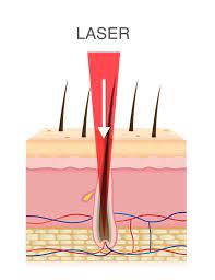 How long will the results of laser hair removal last? Home Laser Ipl Hair Removal Everything You Need To Know