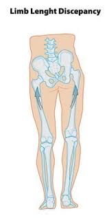 Image result for Functional Leg Length Discrepancy