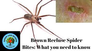 In fact, its venom is a specific enzyme collection. Brown Recluse Spider Bites What You Need To Know Youtube
