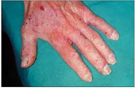 Image result for dermatitis contacta allergica