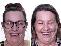 Before & After Gallery