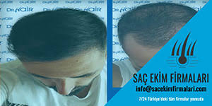 Sac Ekimi Fotograflari Forum Sac Ekimi Mart 2021