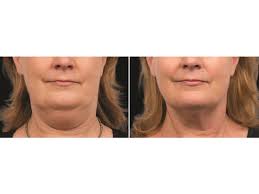 Dr howard webster (plastic surgeon. Belkyra Fat Dissolving Injections For Double Chins