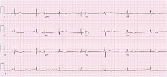 Tachycardia is a heart rate of greater than 100 beats per minute. Sinus Bradycardia Wikipedia