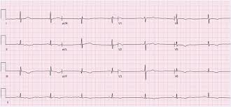 Normal sinus rhythm) refers to the normal heart beat originating from the sinoatrial node. Sinus Bradycardia Wikipedia