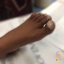 Image result for Clubbing nails feet