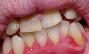 Gingivitis is an inflammation of the gums (gingiva) caused by plaque and bacteria accumulation. The Gum Disease Known As Gingivitis