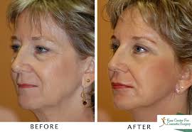 According to the american society of plastic surgeons, face lifts are one of the most popular forms of plastic surgery to reverse the visible signs of a mini facelift, sometimes called a weekend facelift, is most suitable for people who do not require a full facelift and are relatively young with only minor. Is A Weekend Facelift Right For You Kass Center For Cosmetic And Plastic Surgery