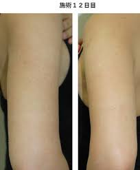 二の腕のぶつぶつ（毛孔苔癬）治療 | みかこクリニック -Mikako Clinic-（形成外科美容外科美容皮膚科）一宮駅東口徒歩１分