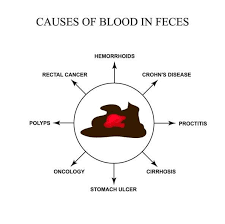 If you're at an average risk for colon cancer, your next colonoscopy should be done in ten years. Invisible Blood In Stool Linked To Various Diseases Gi Associates