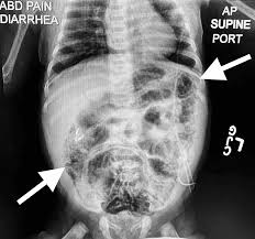 Image result for Necrotizing Enterocolitis