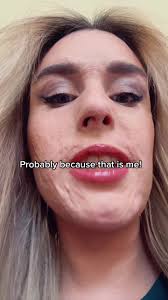 Weird way to be recognised…. but I love when people tell me that my posts  have helped them with their own struggles, whether external or internal… ♥️  #survivor #burnssurvivor #erutionsurvivor #burns ...