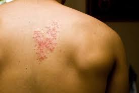 Image result for shingles in children