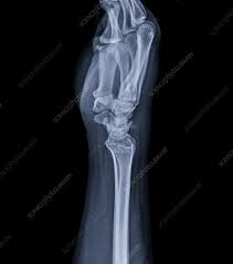 Image result for Wrist XRay