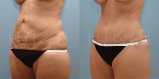 Image result for Liposuction