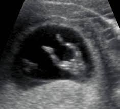 The timing of this depends on the person's job and the. Normal 1st Trimester Ultrasound How To