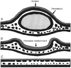 Image result for Cephalhematoma